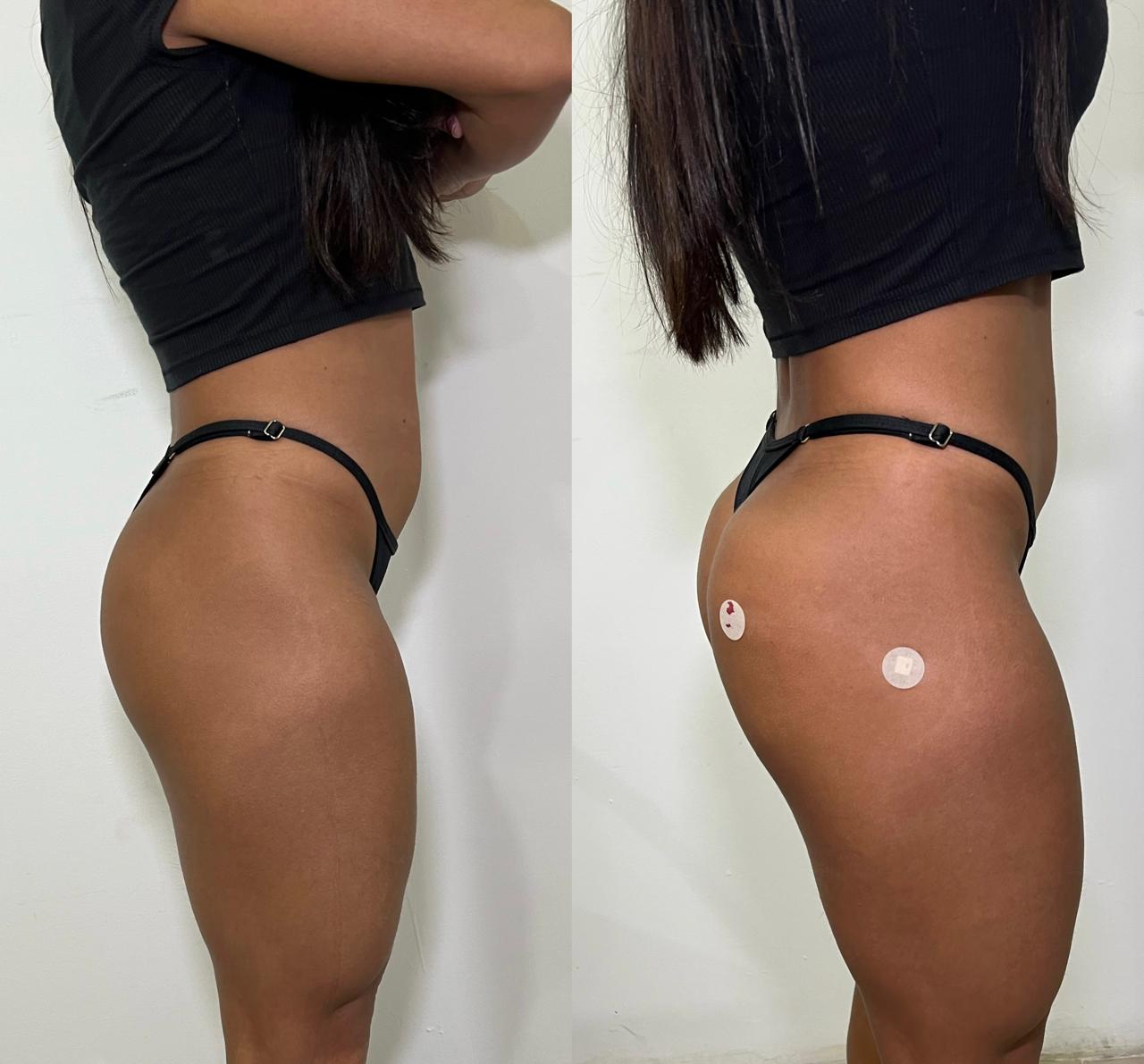 Antes e depois de harmonização glútea no Rio de Janeiro, caso 07, vista lateral. Resultado natural com a Dra. Sabrina Sousa