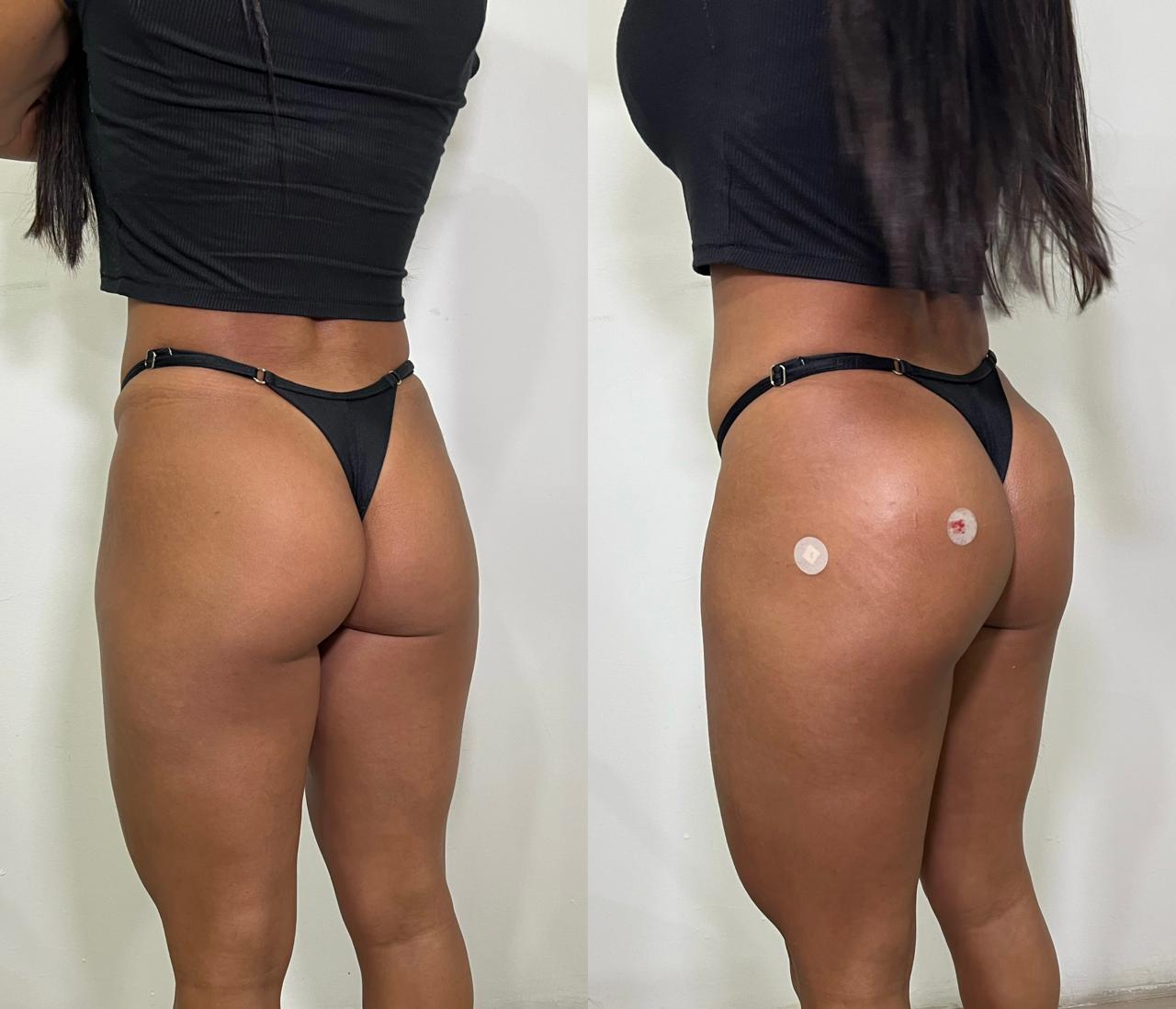 Antes e depois de harmonização glútea no Rio de Janeiro, caso 07, vista posterior. Resultado natural com a Dra. Sabrina Sousa