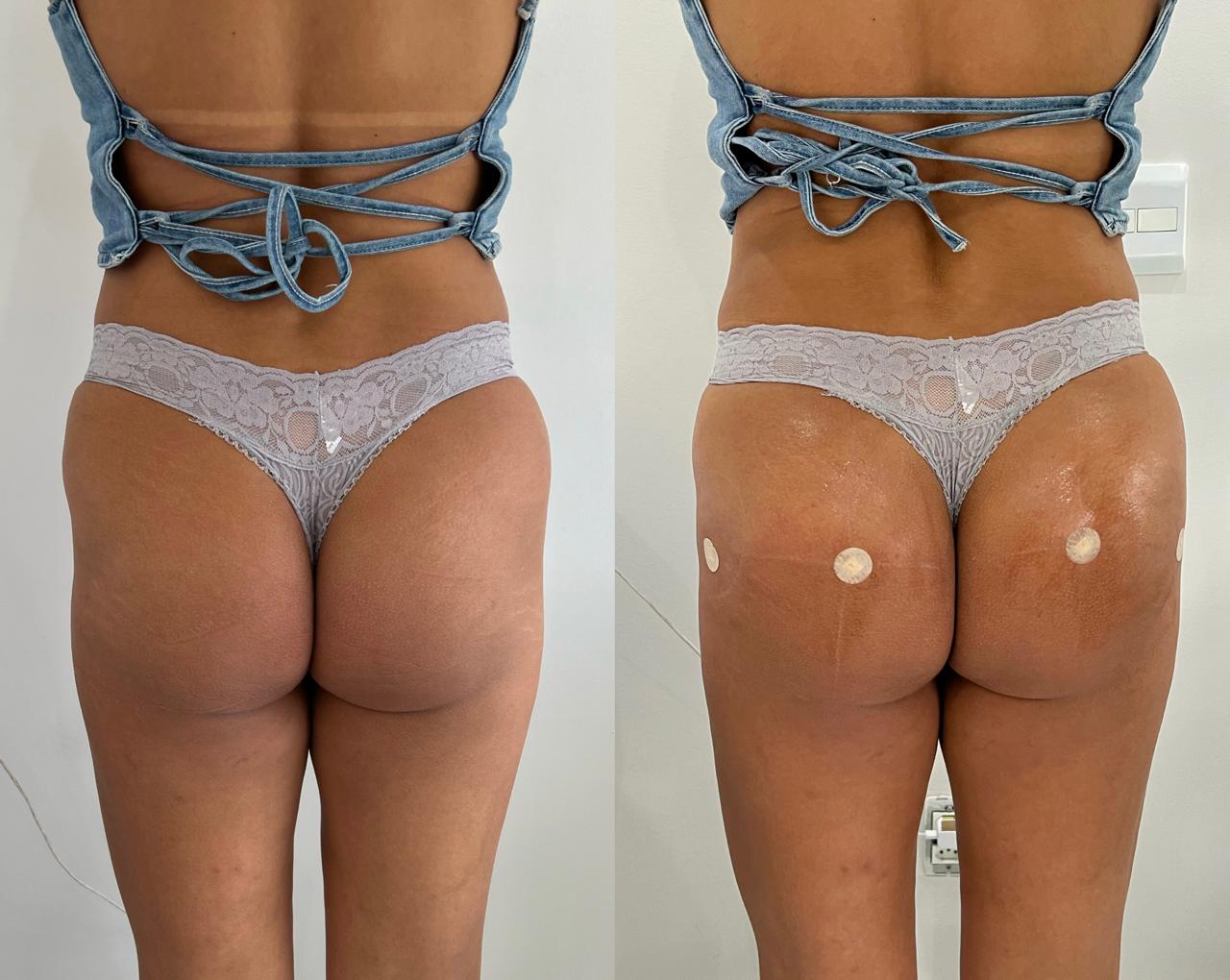 Antes e depois de harmonização glútea no Rio de Janeiro, caso 08, vista posterior. Resultado natural com a Dra. Sabrina Sousa