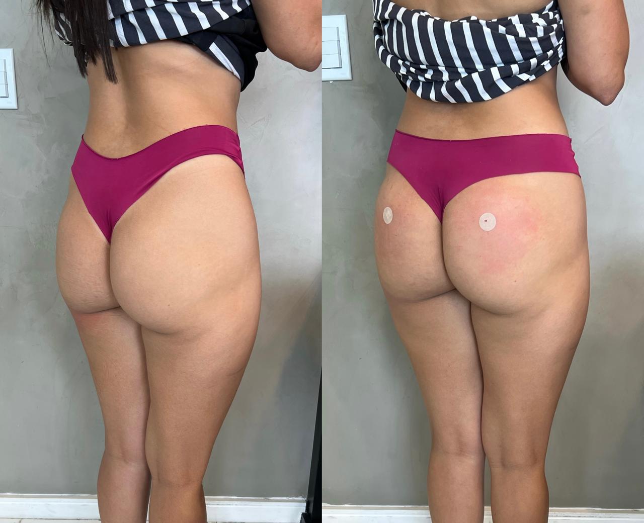 Antes e depois de harmonização glútea no Rio de Janeiro, caso 09, vista lateral. Resultado natural com a Dra. Sabrina Sousa