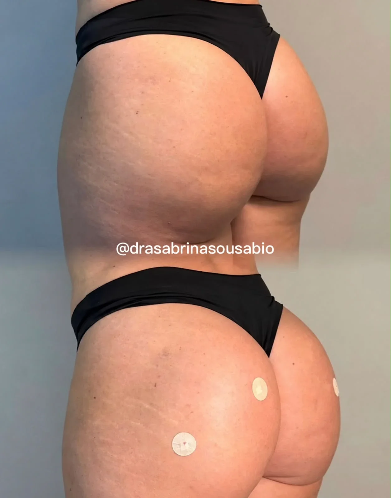 Antes e depois de harmonização glútea no Rio de Janeiro, caso 03, vista posterolateral. Resultado natural com a Dra. Sabrina Sousa