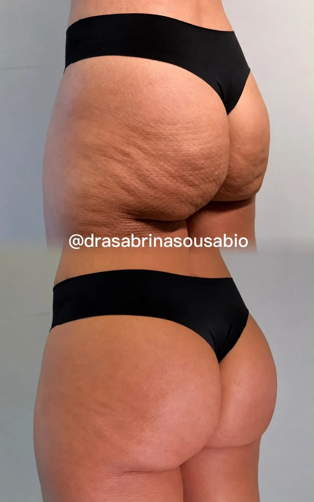 Antes e depois de harmonização glútea no Rio de Janeiro, caso 04, vista posterolateral. Resultado natural com a Dra. Sabrina Sousa