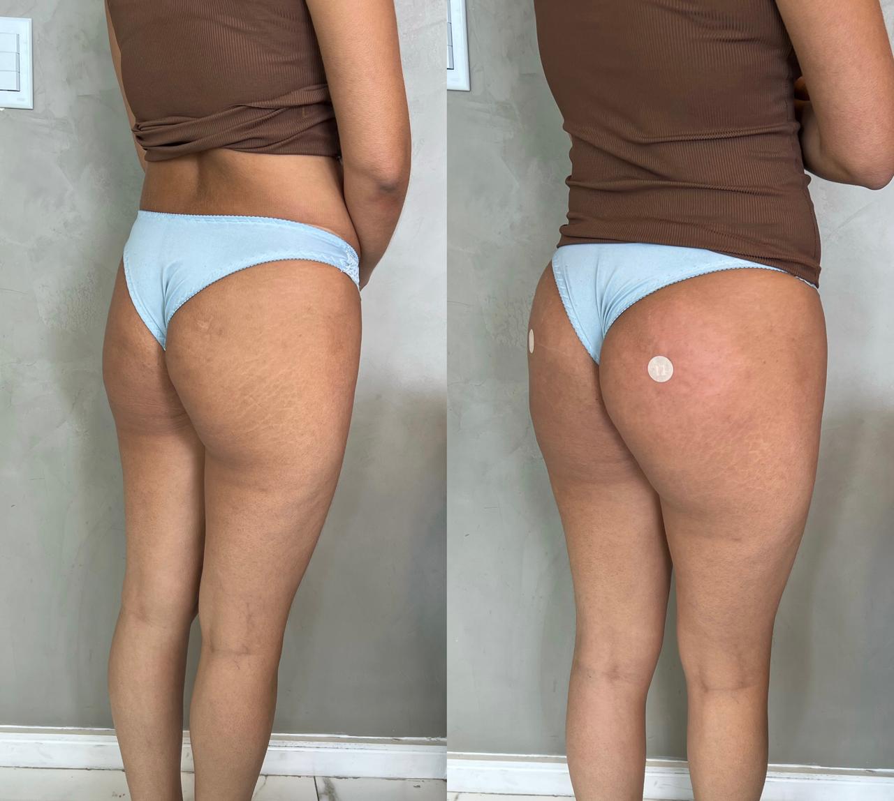 Antes e depois de harmonização glútea no Rio de Janeiro, caso 11, vista lateral. Resultado natural com a Dra. Sabrina Sousa