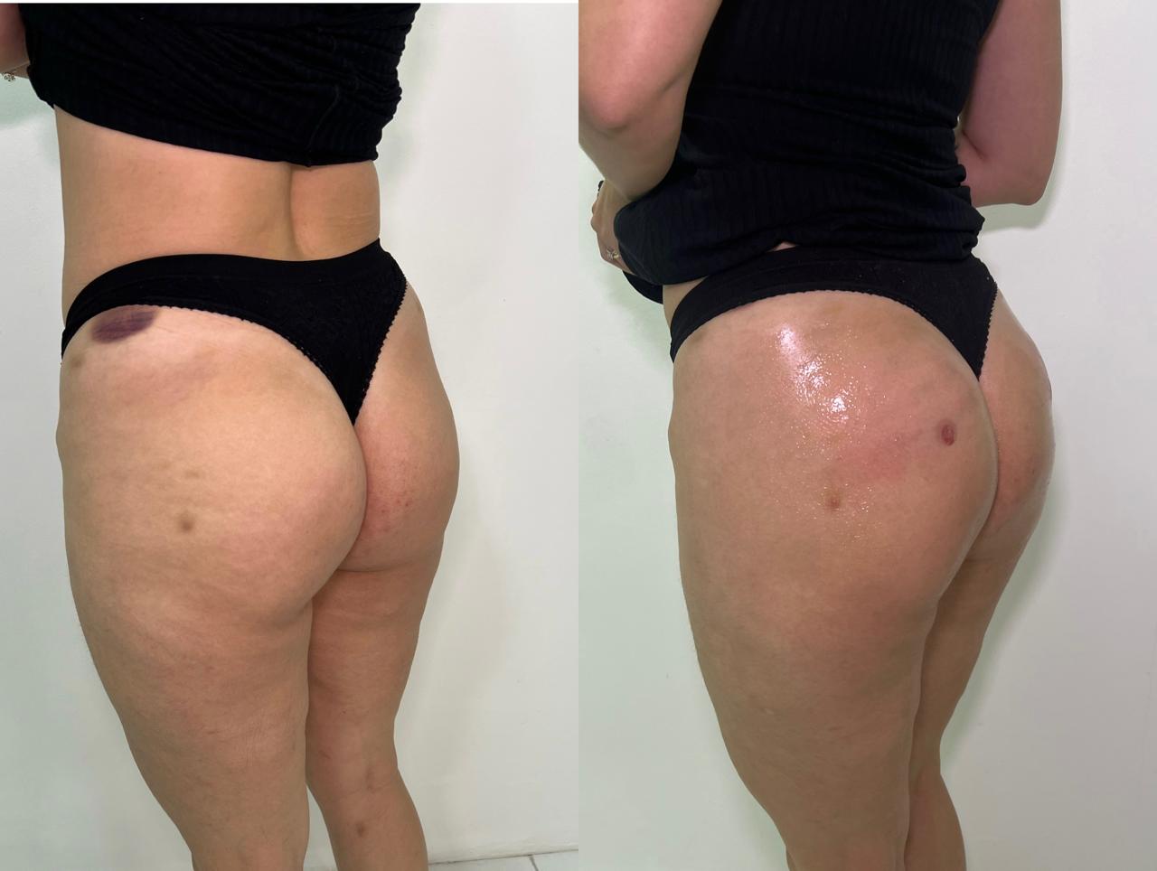 Antes e depois de harmonização glútea no Rio de Janeiro, caso 12, vista lateral. Resultado natural com a Dra. Sabrina Sousa
